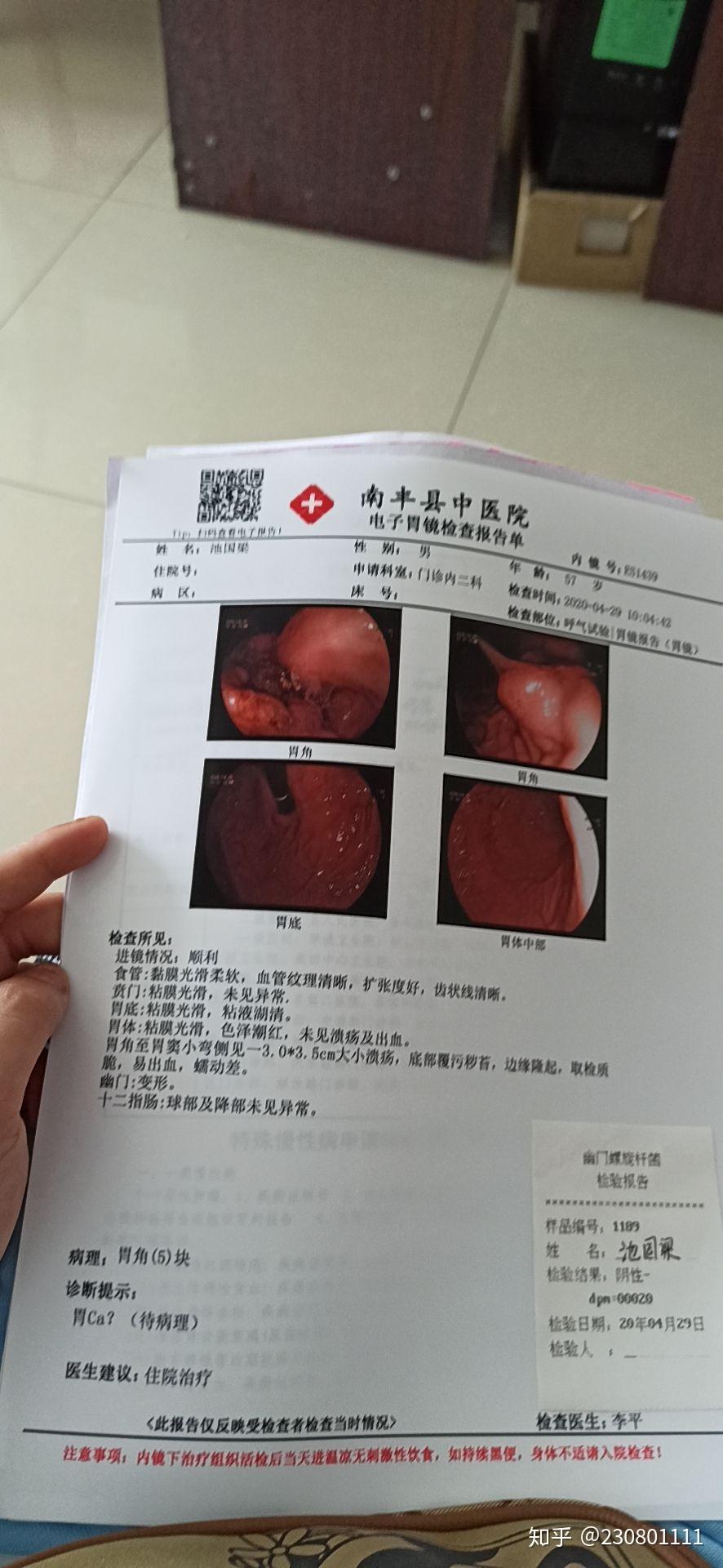 胃癌晚期单子图片图片