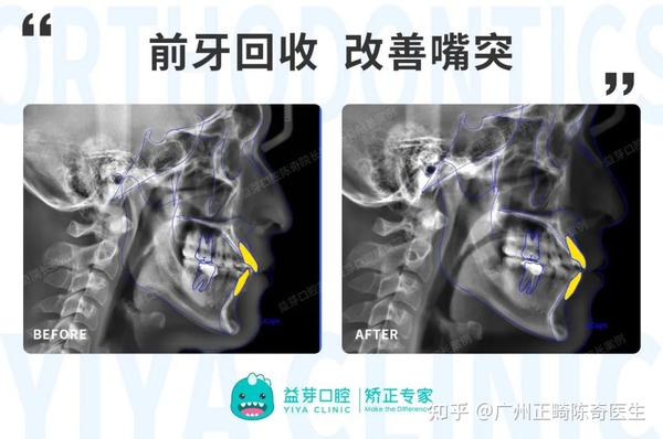 【正畸美学】揭秘“笑线”给笑容带来的变化！一起解锁自信笑容 - 知乎