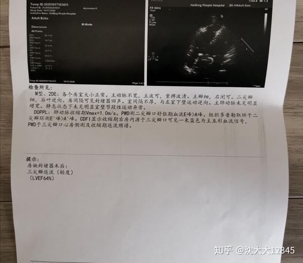 先心病房缺19mm介入封堵术后分享