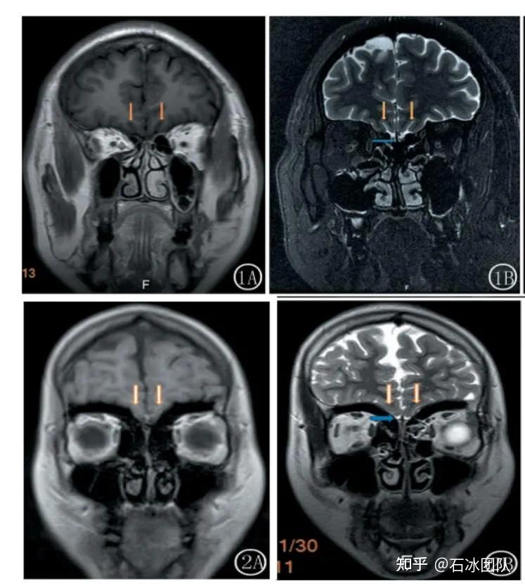 贾仲林副教授谈谈kallmann综合征