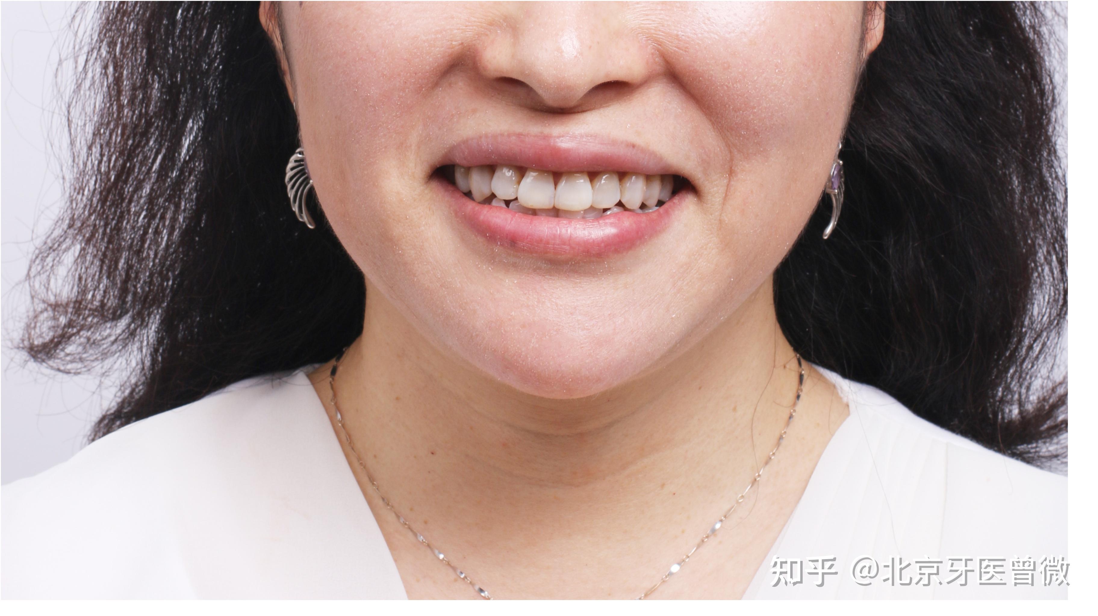 南宁牙齿矫正|常说的牙齿中线不齐是什么？有必要矫治吗？ - 知乎