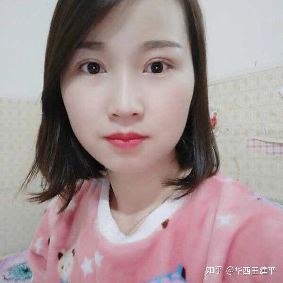 7mm双眼皮术后案例反馈