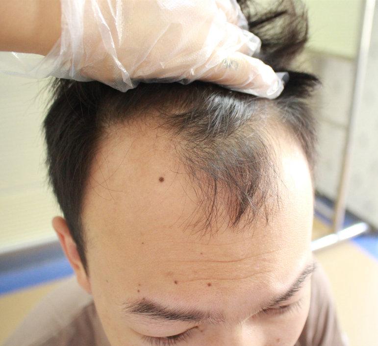 1人 赞同了该文章 m型脱发是指的男性雄激素性脱发中最常见的一种发型