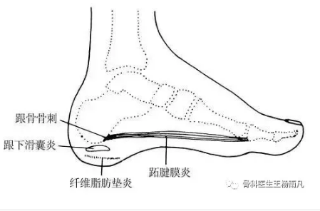 腳踏實地也不易六問六答讓你徹底瞭解跟痛症腳後跟疼痛