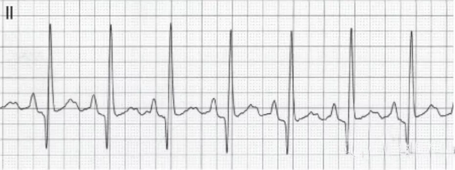 【铎悦干货】解析心电图基础(二),看完绝不后悔 - 知乎