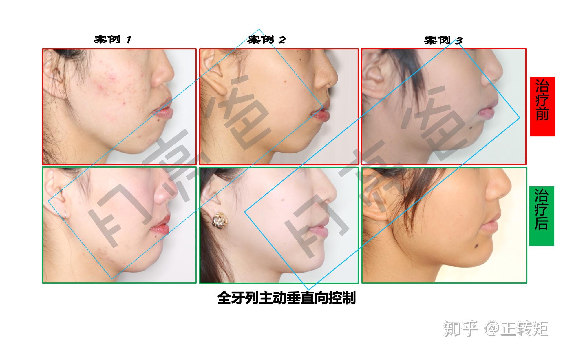 正畸治疗中的面型变化