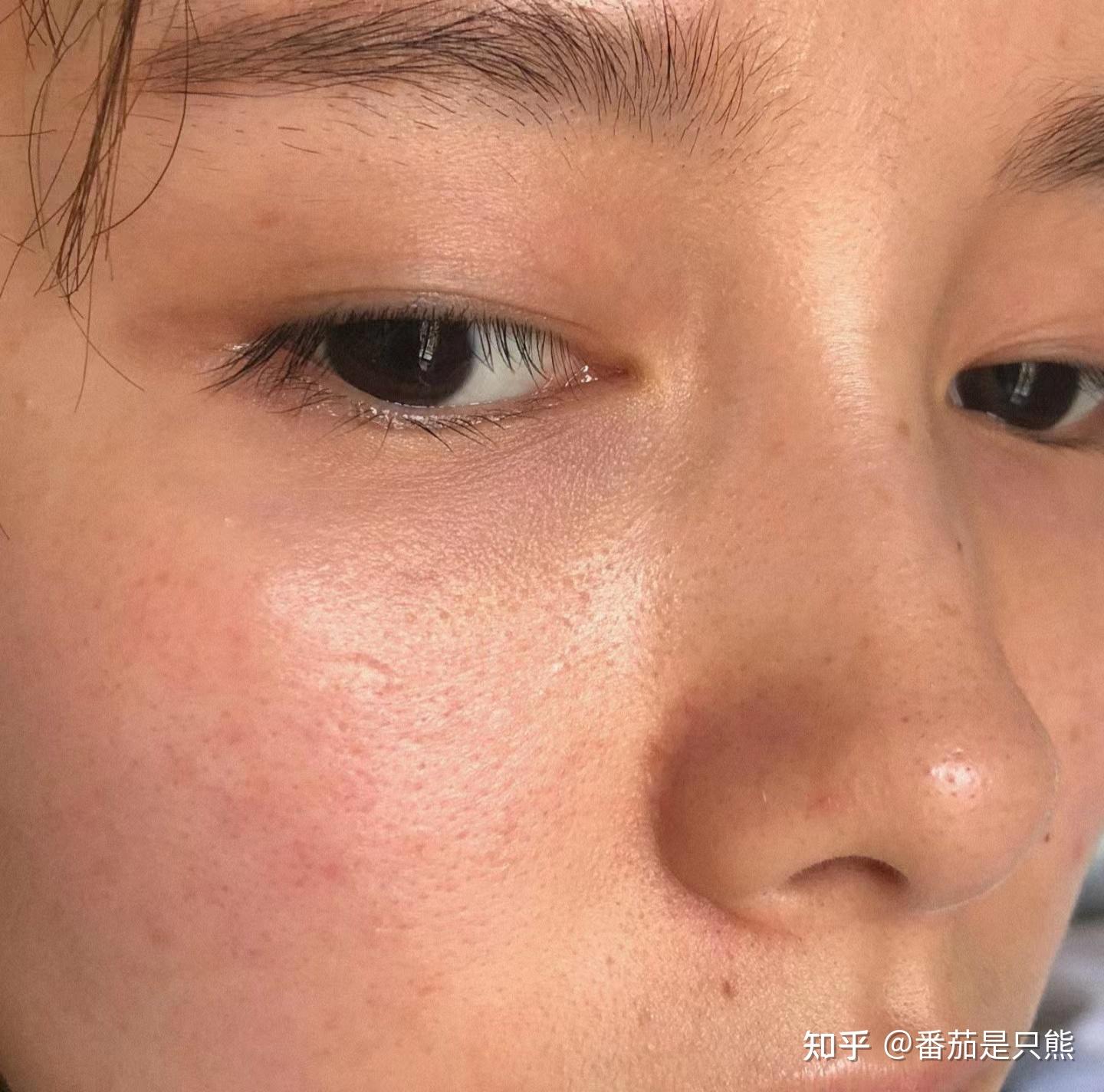 经常熬夜皮肤越来越差怎么办