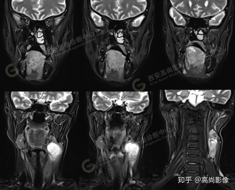 【西安高尚医学影像诊断中心病例】口腔鳞状细胞癌2例 - 知乎