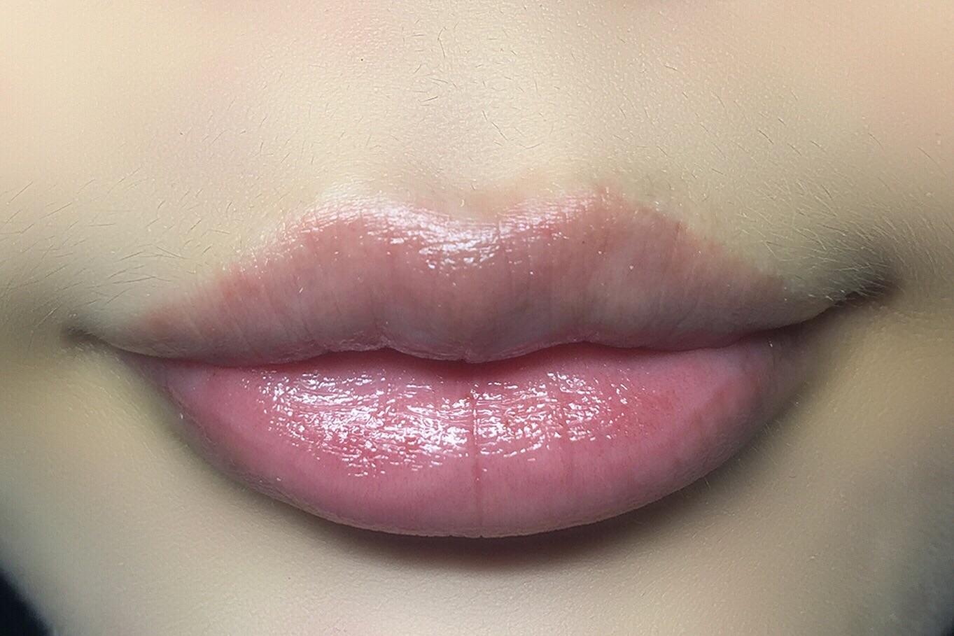 小百科：玻尿酸唇注射专科，专业打造完美唇形-蜜颜优惠