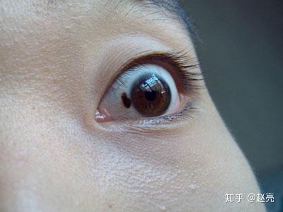 太田痣眼球图片