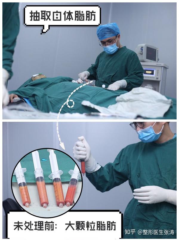 脂肪移植黑科技——SVF-gel脂肪干细胞胶 - 知乎