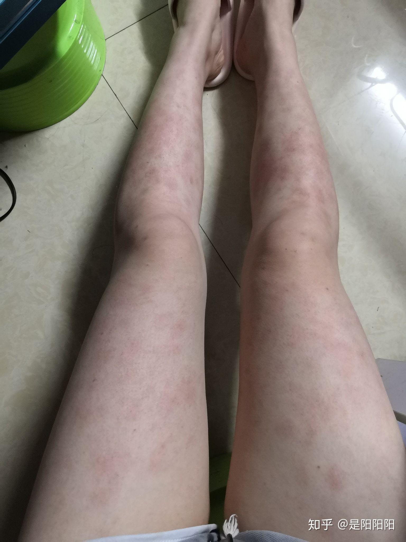 过敏性紫癜一个月了