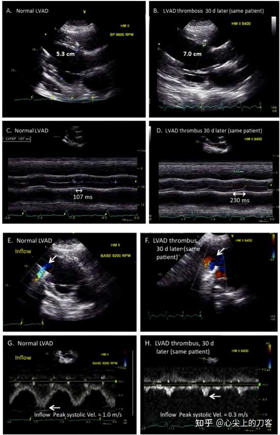 美国超声心动图学会指南及标准超声心动图在左心室辅助装置管理中的应用 - 知乎