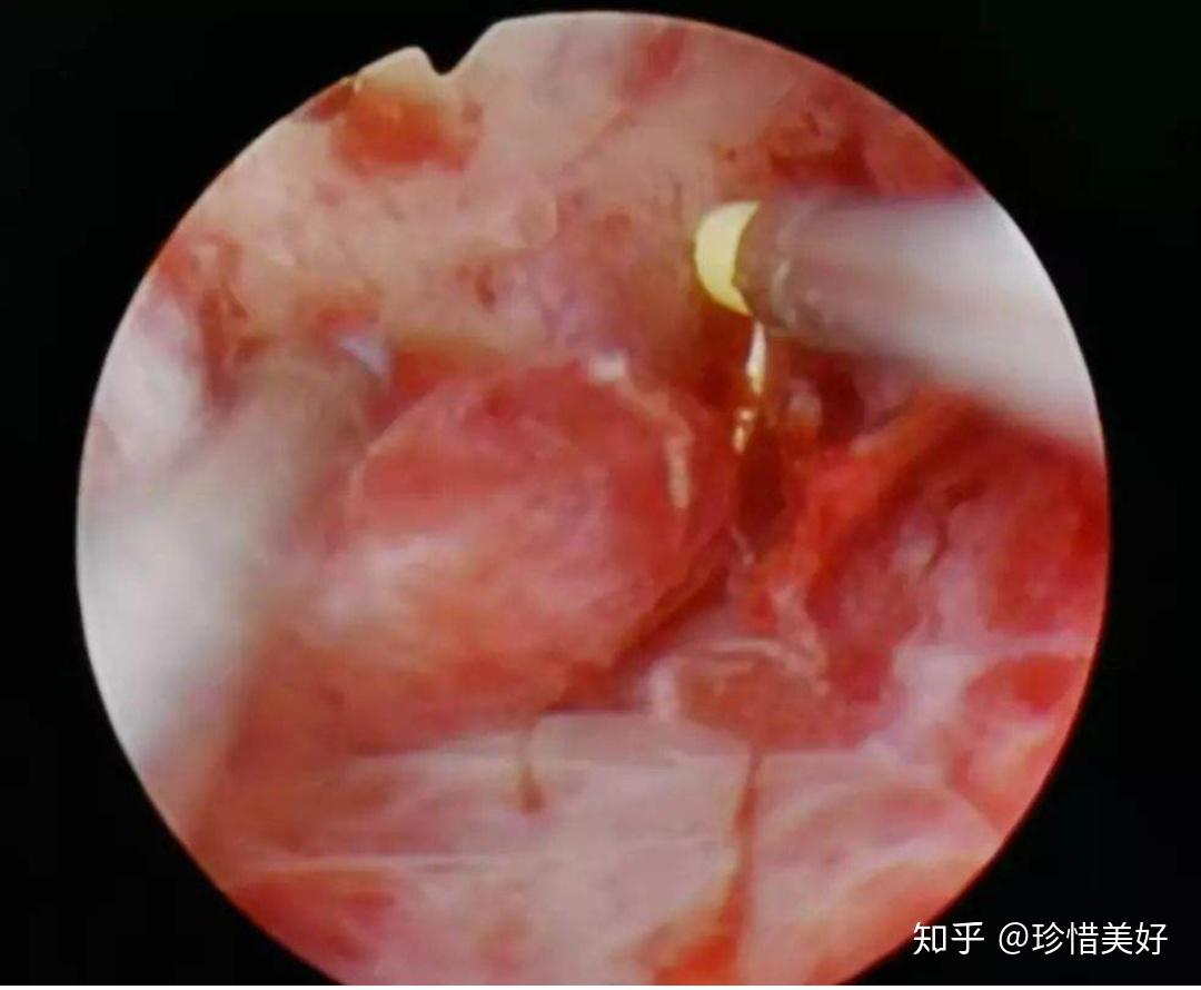 宫腔镜下子宫内膜息肉治疗你了解多少