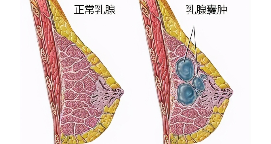 乳腺囊肿的症状图片