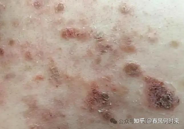服用激素治疗天疱疮的患者,绝大多数都后悔了,激素的副作用让患者无法承受! - 知乎