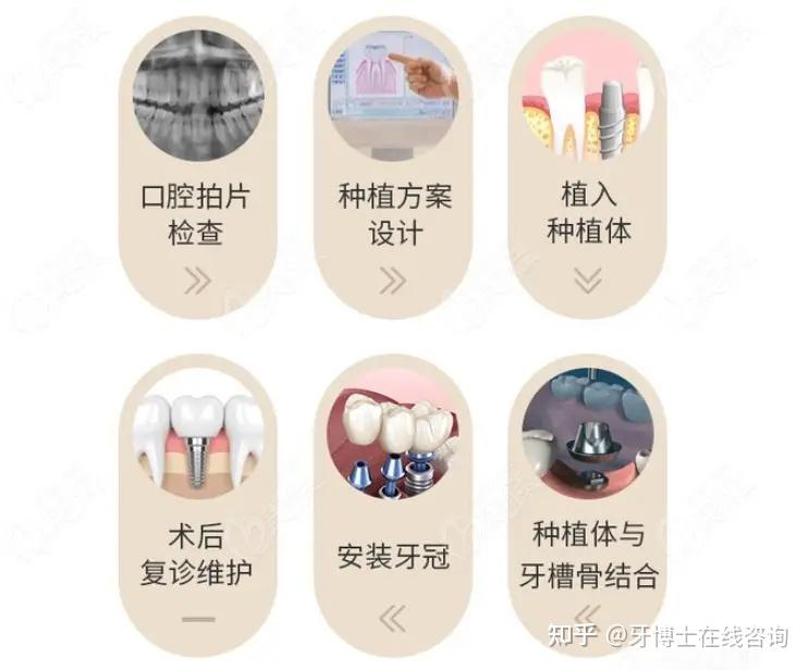 全口种植牙大概需要多少钱过程呢时间要多久