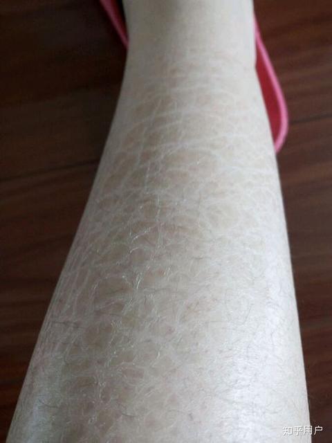 皮肤上局部有鸡皮屑(皮肤上局部有鸡皮屑怎么回事) 皮肤上局部有鸡皮屑(皮肤上局部有鸡皮屑怎么回事)