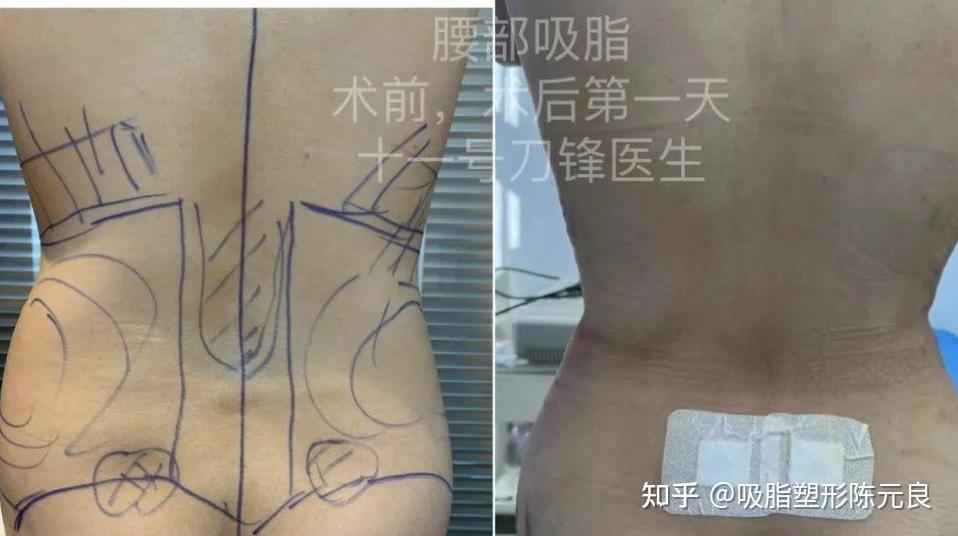 腰腹部肥胖环行吸脂减肥塑形的案例分析 - 知乎