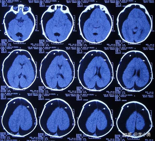 6月内4家医院双颞巨大蛛网膜囊肿术后变硬脑膜下积液,反复引流又成脑