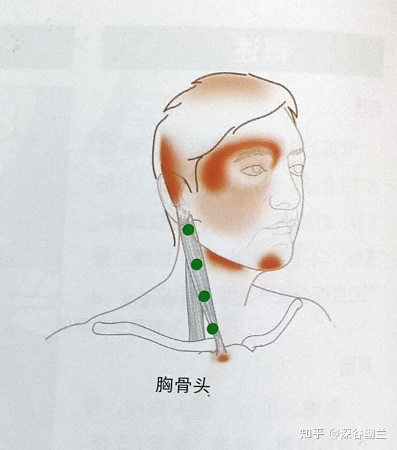 1,胸鎖乳突肌激痛點牽涉痛:頭頂頭痛與胸鎖乳突肌與頭夾肌產生激痛點