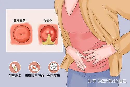 慢性炎症,或者由于分娩,流产,宫腔操作等引起宫颈裂伤继发感染造成