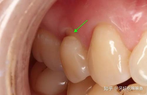 牙齒痠痛可能不是蛀牙而是楔狀缺損