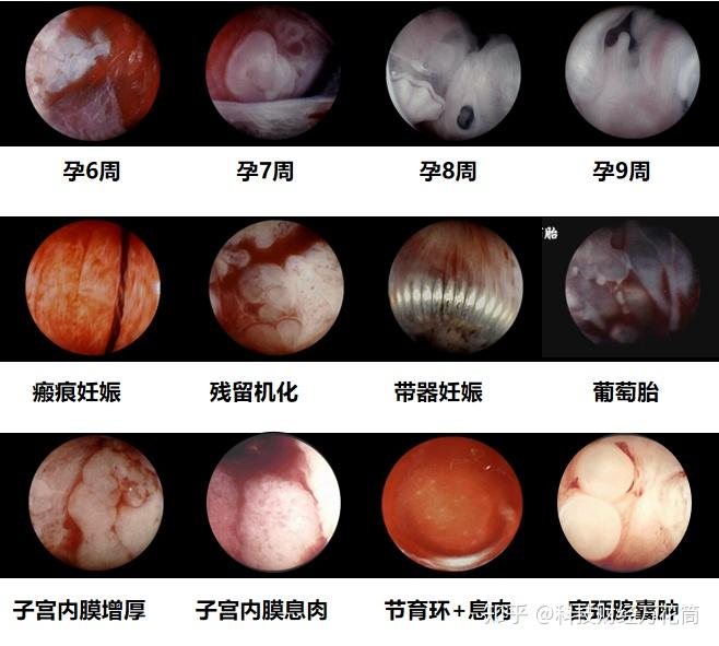 做人流为什么专家都建议选择gynovision可视流产吸引手术