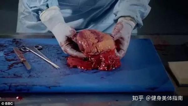 bbc拍摄解剖了一个200斤的女肥胖患者揭开肥胖对身体的影响