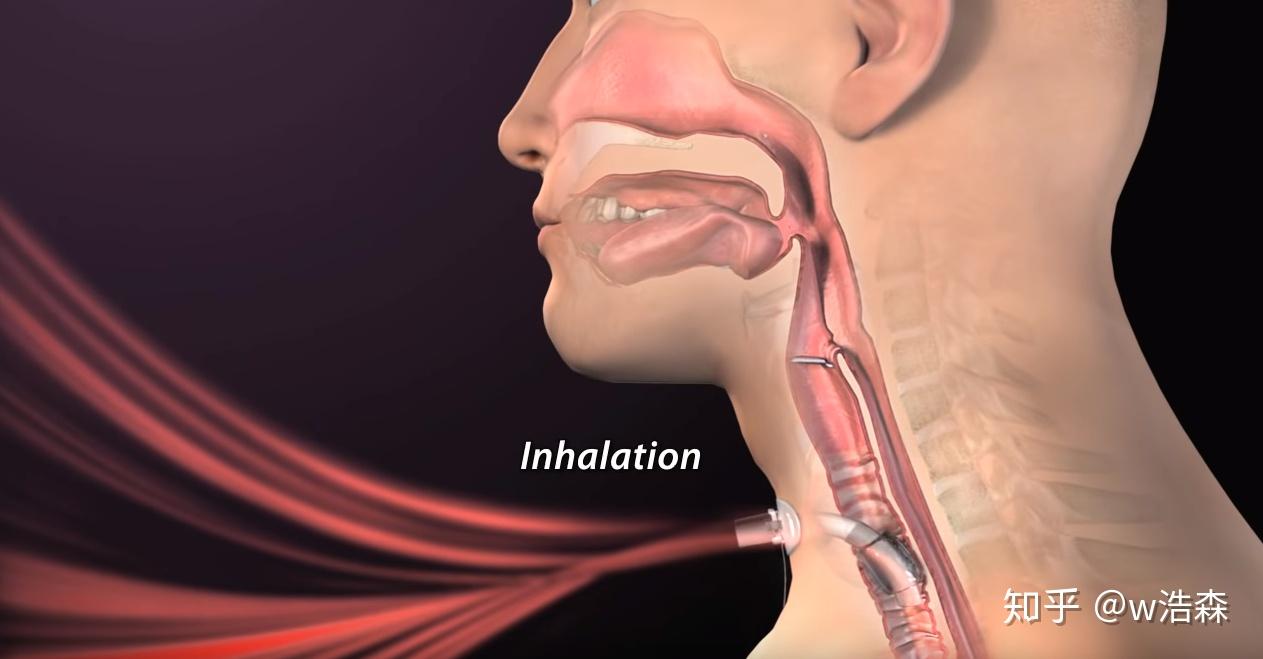 如果病人已经失去意识,或上呼吸道已阻塞,则应该进行气管切开术,又叫"