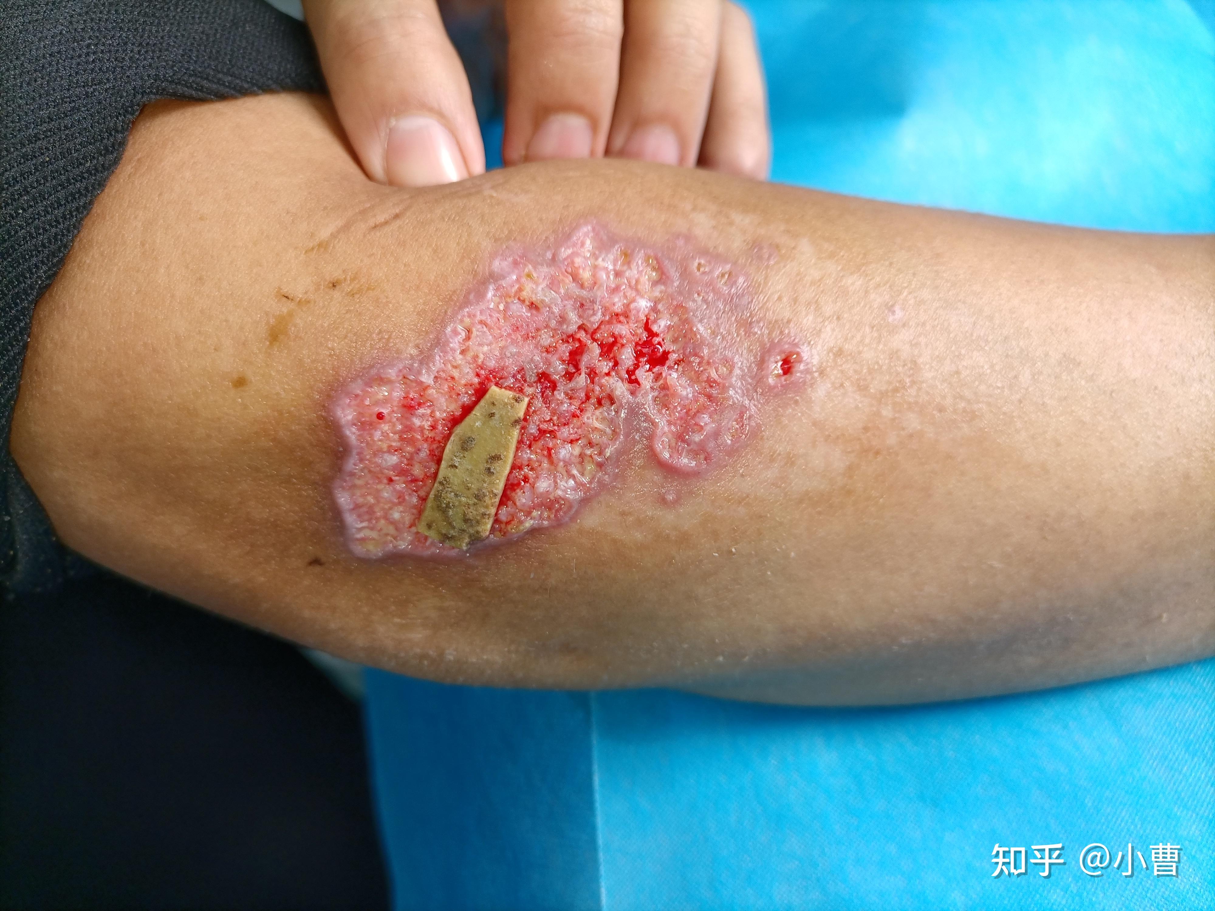 一位创面患者带来的感触