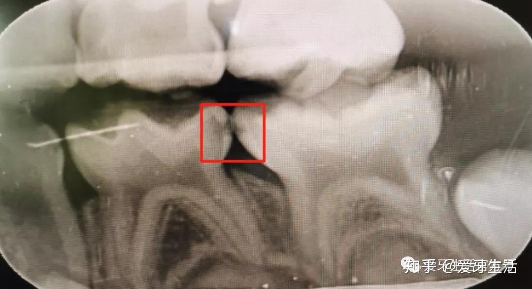 今天我们讲一讲"隐藏的龋齿"——邻面龋