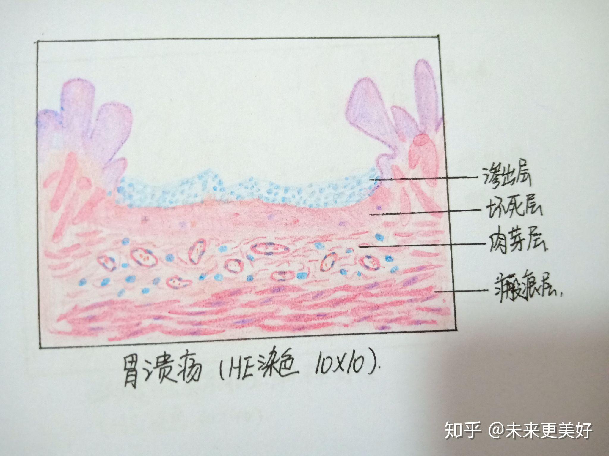 胃粘液腺癌手绘图图片