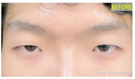 18岁少年因眼睛太小做双眼皮开眼角术后一个月,变化令人惊喜!