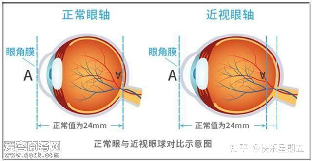 是眼睛結構已經改變了,表現在眼軸增長超出了正視化的長度,眼軸的長度