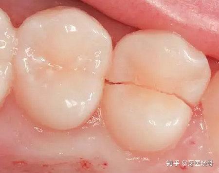 牙齿断裂怎么修复
