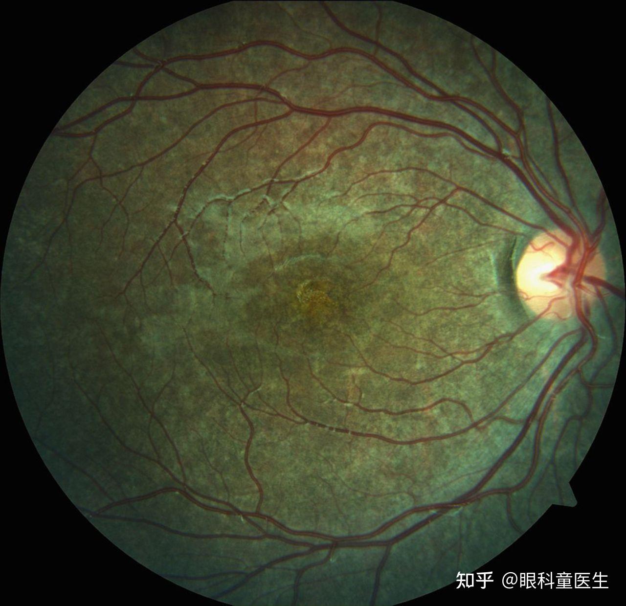9个问题让你彻底读懂：糖尿病眼底病变做激光治疗是怎么回事_视网膜