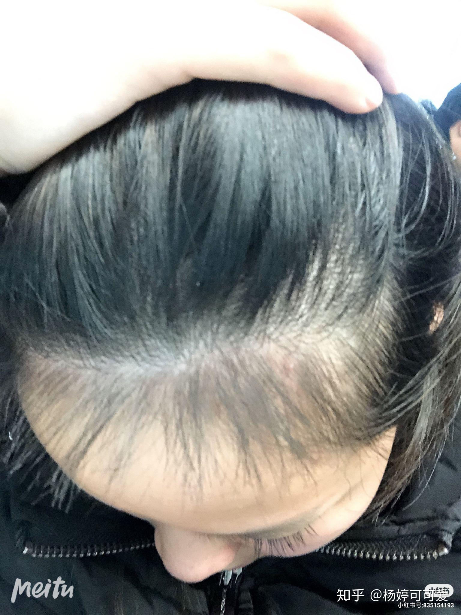 植发两个月的效果