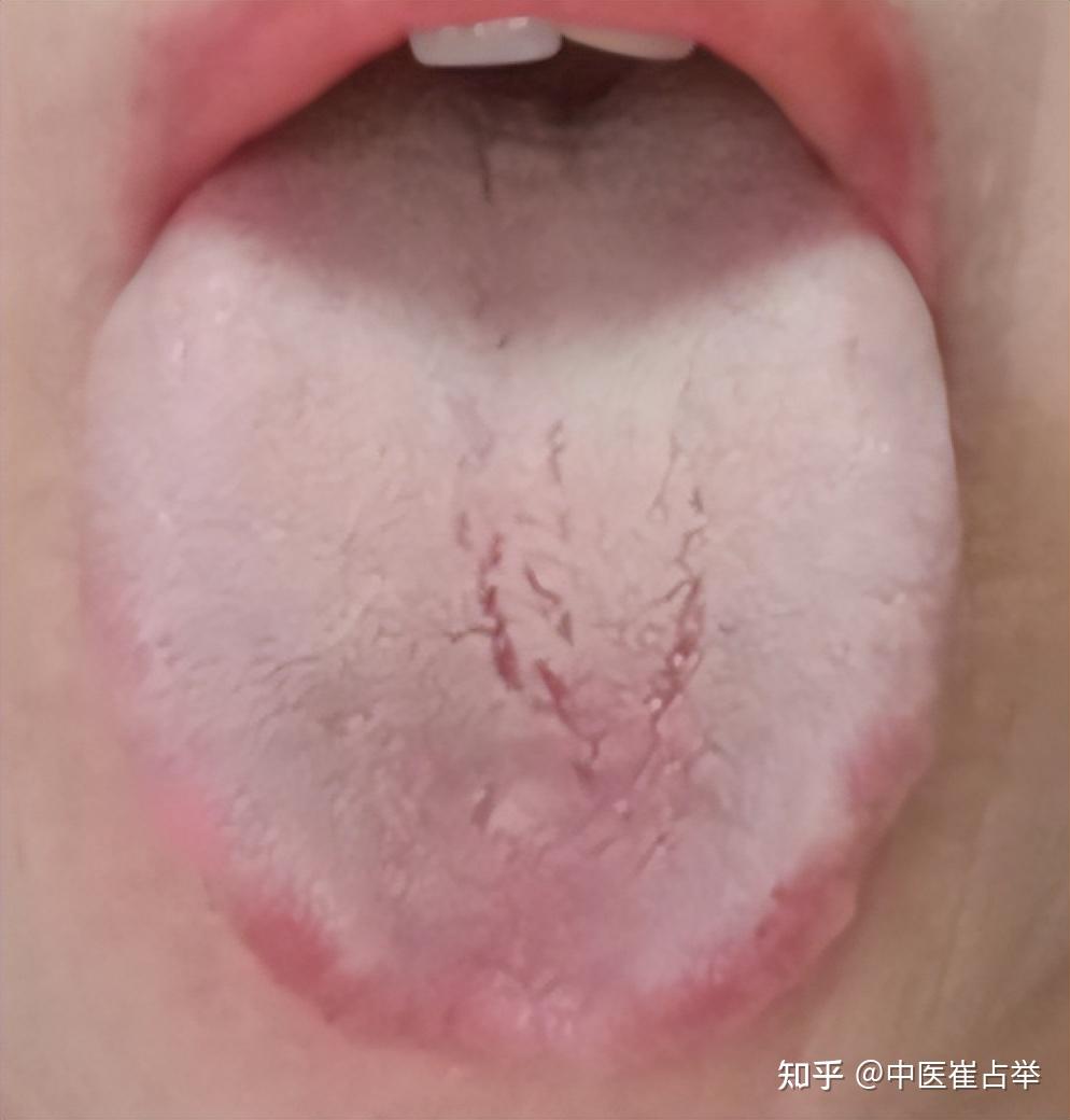 身体好不好,看舌头就知道:肝郁气滞,痰多,脾胃虚弱,肾气亏虚 - 知乎
