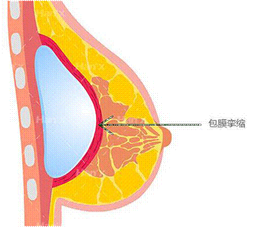 假体隆胸后手感硬就是包膜挛缩吗?