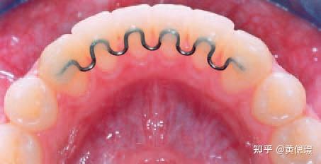 舌弓间隙保持器图片