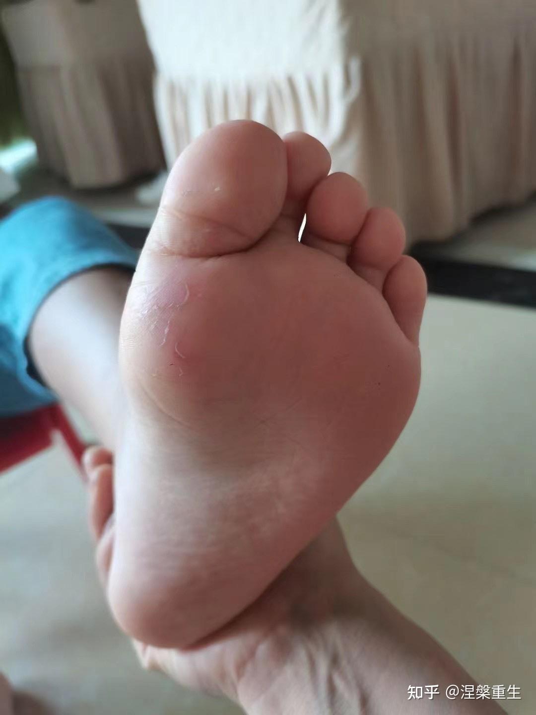 小孩被传染脚气3小孩被传染体癣另外,再补充一下,脚气还是导致女性