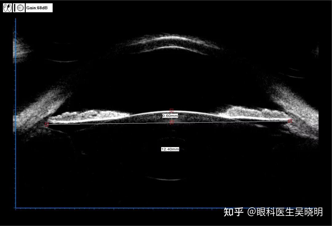 虹膜睫狀體囊腫,房角關閉術後檢查icl植入術後最重要的檢查便是鏡片後