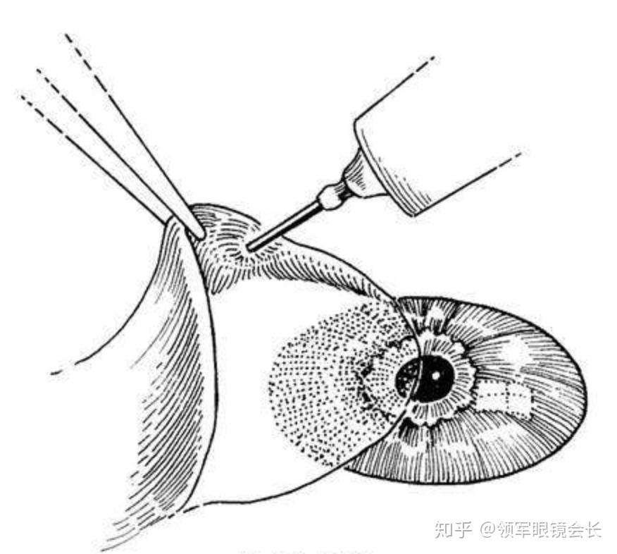 翼状胬肉是什么鬼?