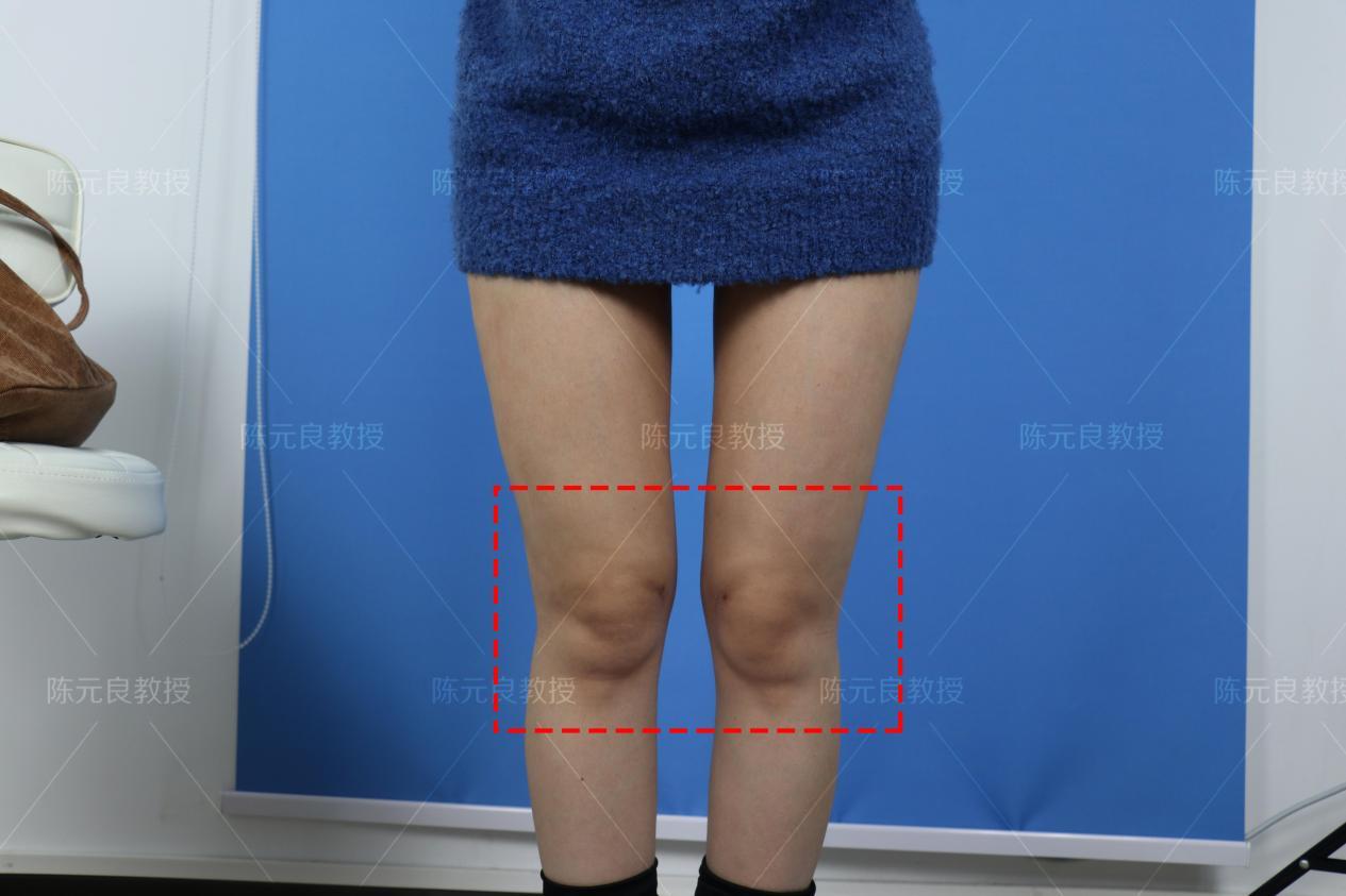 脂肪医生韩炜谈整形：直腿术比大腿吸脂好在哪里？ - 哔哩哔哩