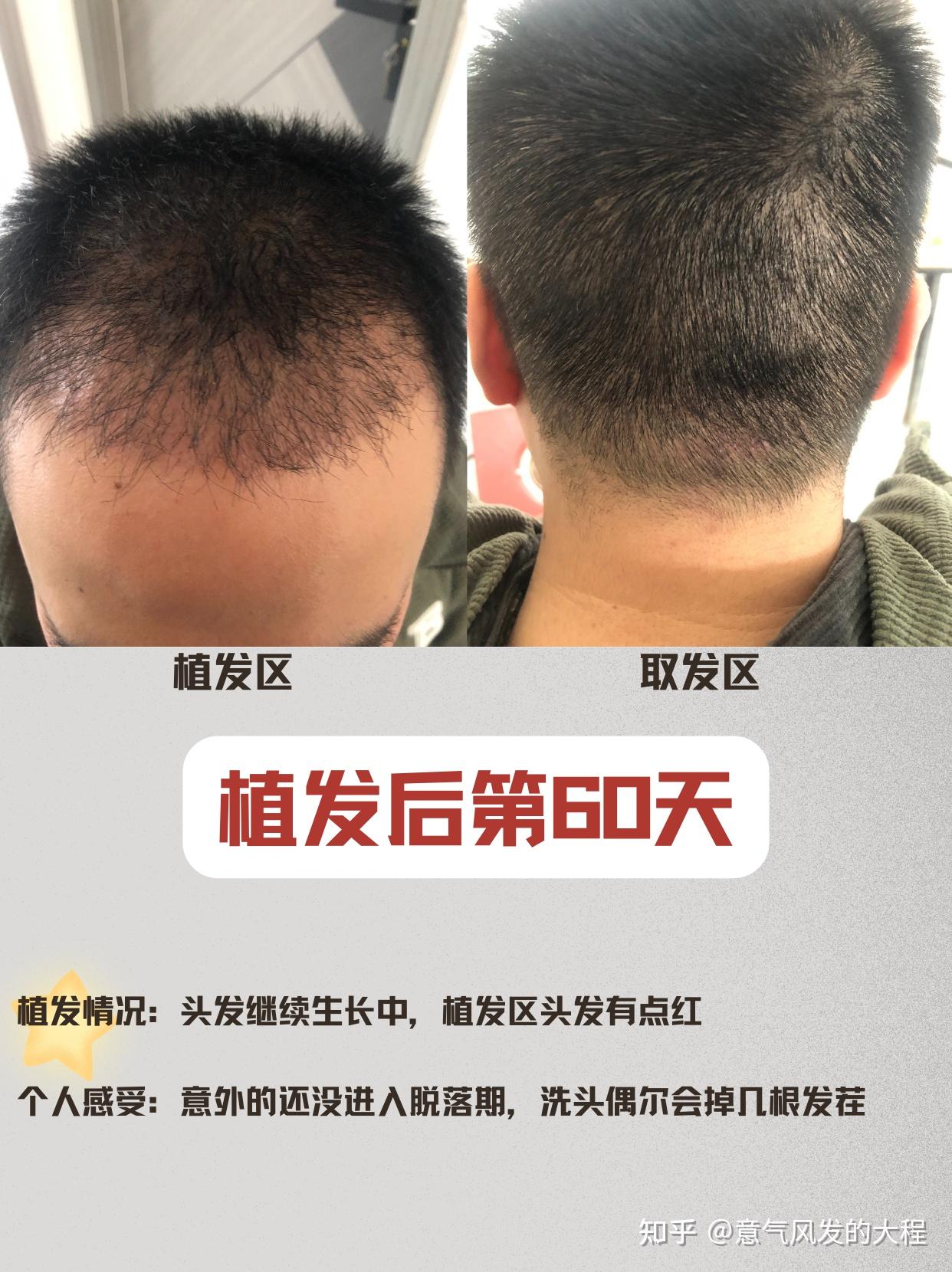 医学硕士植发辛酸史，植发后1-375天的恢复全记录 - 知乎