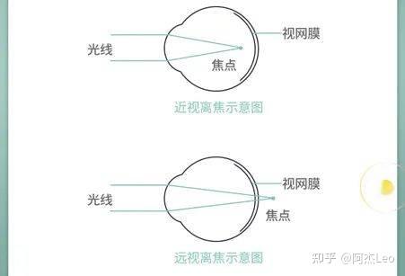 关于近视离焦镜片的深度了解,蔡司、依视路、豪雅选哪个好? - 知乎