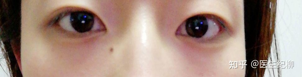 为什么你的双眼皮和别人的不一样?内双到底是双眼皮还是单眼皮? - 知乎