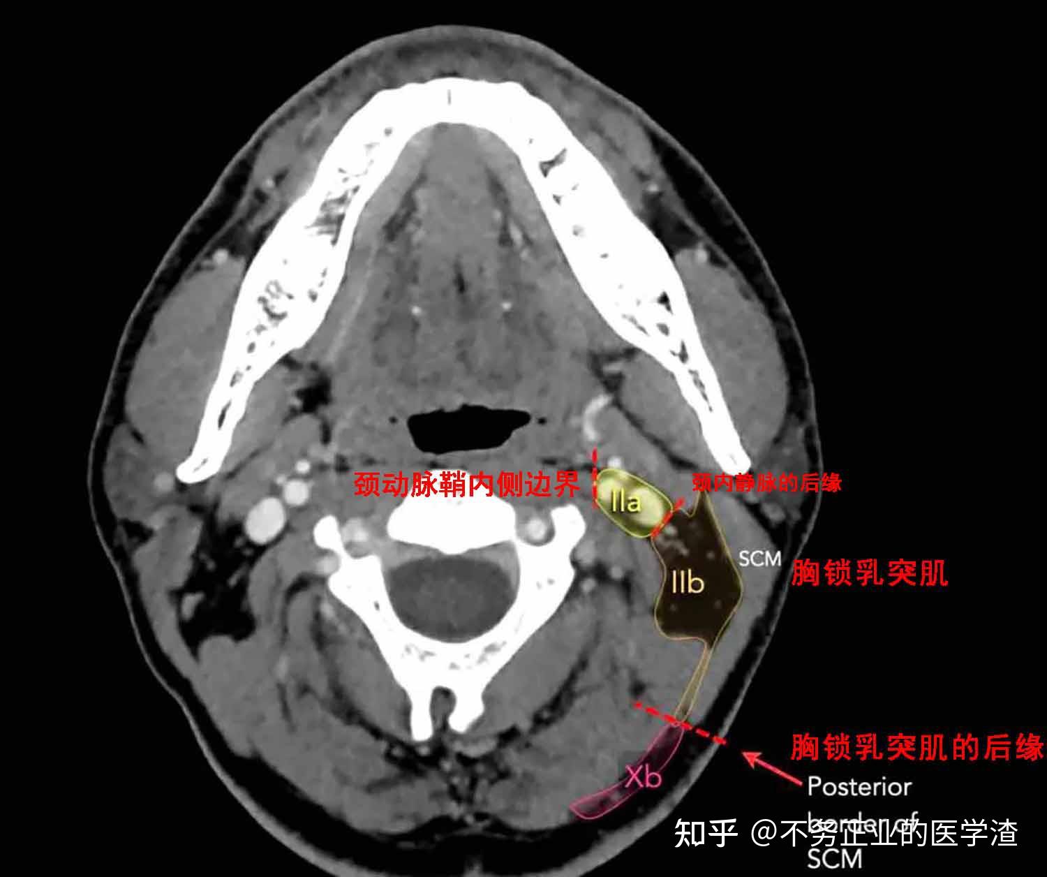 颈静脉孔ct解剖图图片