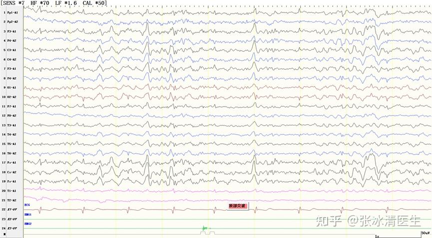 正常睡眠脑电图 - 知乎